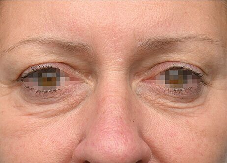 yeux avant emface