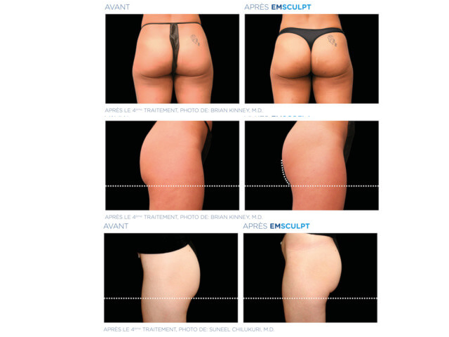 vos fesses sont tonifiés, raffermit, rebondies et liftées, remodelage des fessiers,