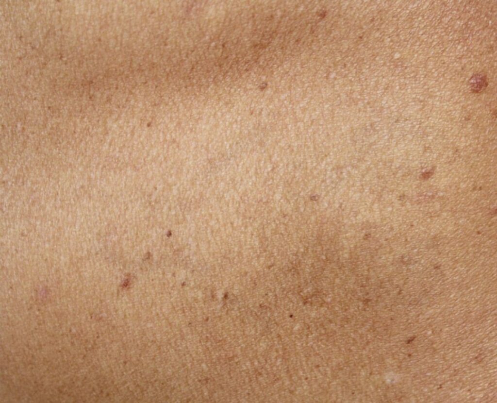 detatouage après